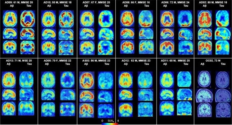PET del cerebro que muestra placas amiloides y proteínas tau en Alzheimer | DEAN WONG, M.D., PH.D. AND AYON NANDI, M.S., PH.D. ep petcerebromuestra placas amiloidesproteinas taualzheimer 20190510173413