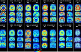 ep petcerebromuestra placas amiloidesproteinas taualzheimer 20190510173413
