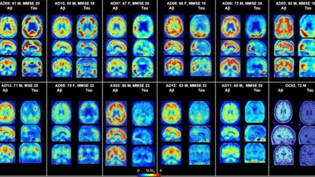 ep petcerebromuestra placas amiloidesproteinas taualzheimer 20190510173413