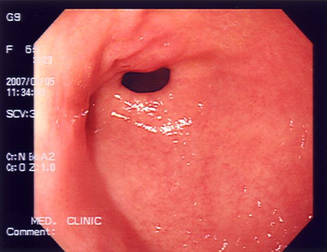 Imagen De Una Endoscopia | WIKIMEDIA COMMONS/IGNIS ep imagenuna endoscopia