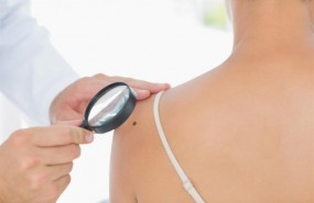 ep lunares cancerpiel melanoma