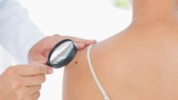ep lunares cancerpiel melanoma