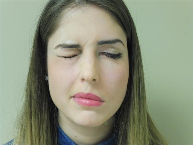 Parálisis facial | CEDIDA POR COM SALUD ep paralisis facial