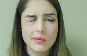 ep paralisis facial