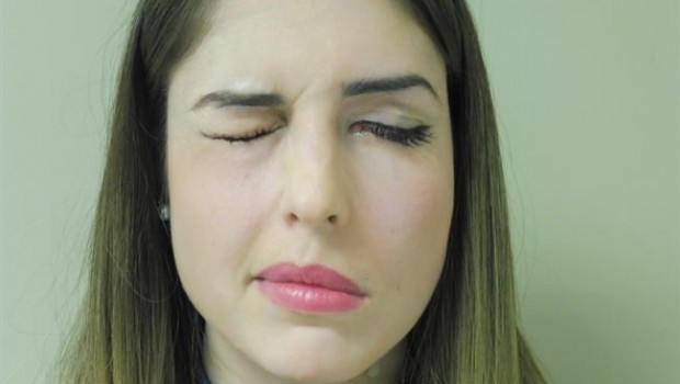 ep paralisis facial