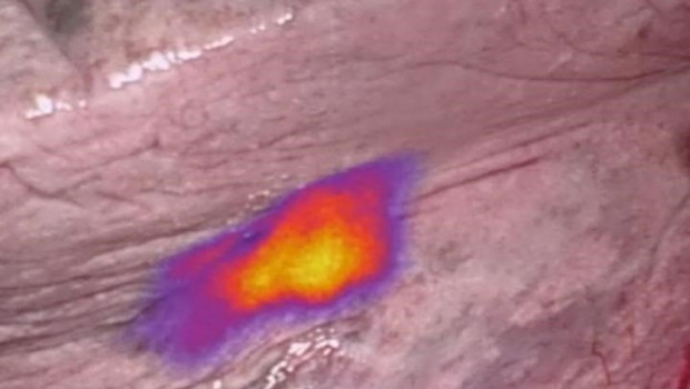 ep los marcadores fluorescentes ayudan a los profesionales medicos a identificar y eliminar las