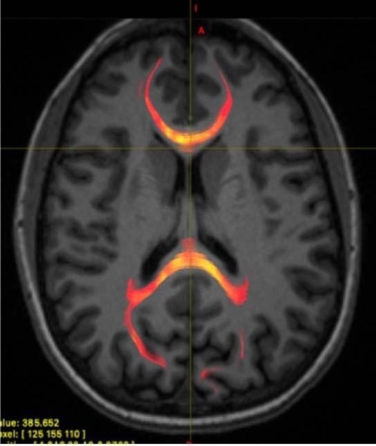 ep imagen de rmn de un paciente con lesion cerebral traumatica leve que muestra tractografia de