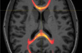 ep imagen de rmn de un paciente con lesion cerebral traumatica leve que muestra tractografia de