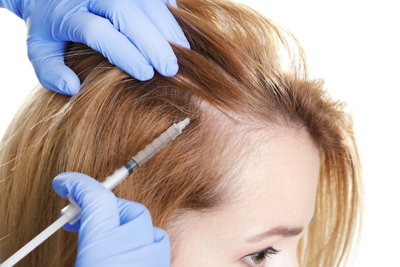 ep alopecia femenina