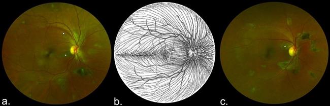 ep imagenesla retina