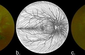 ep imagenesla retina