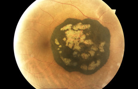 nevus benigno de dios garcia magdalena vision art 