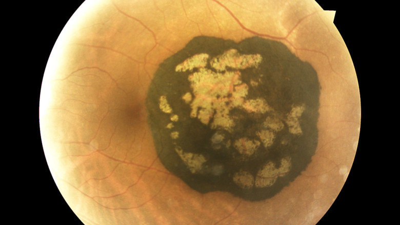 nevus benigno de dios garcia magdalena vision art 