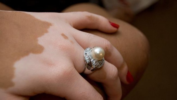 ep manovitiligo
