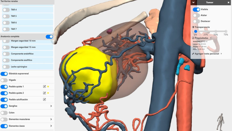 modelo 3d renal cella medical solutions 1