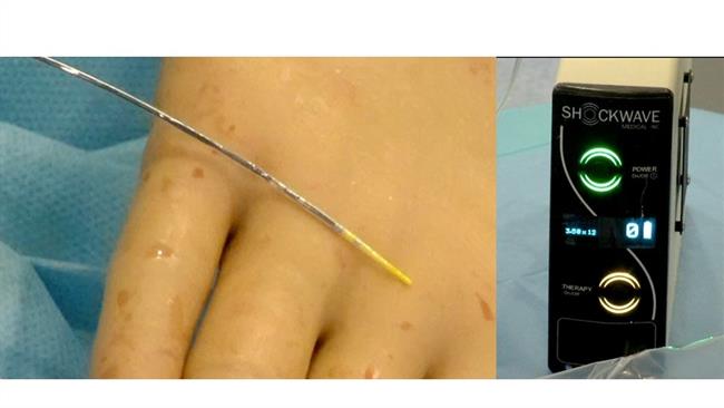 ep ondaschoquetratar estenosisarterias coronarias calcificadas
