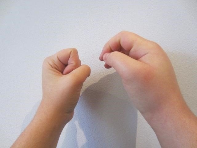 ep hinchazon en una mano causada por angioedema hereditario