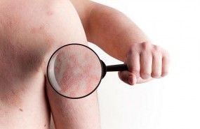 ep psoriasis enfermedad inflamatoria