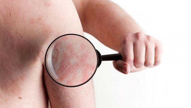 ep psoriasis enfermedad inflamatoria