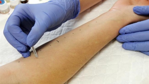 ep pruebas cutaneasalergia