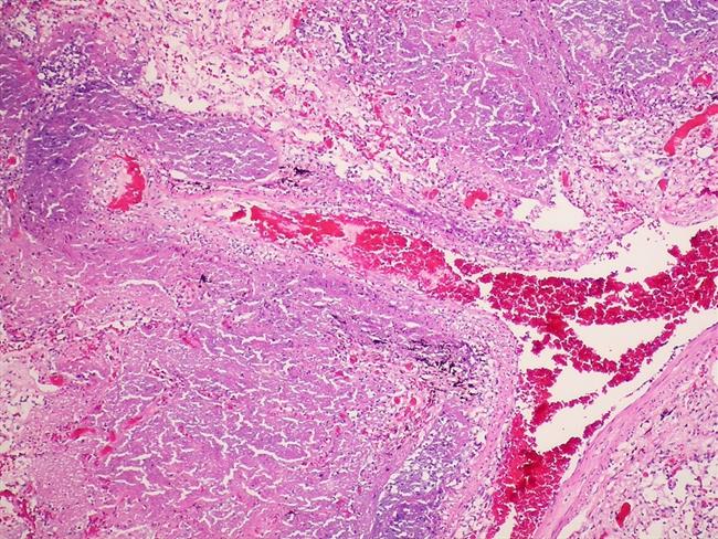 Tuberculosis | FLICKER/ PULMONARY PATHOLOGY ep tuberculosis 20170324132504
