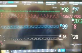 ep el respirador andalucia respira supera con exito el segundo ensayo en humanos