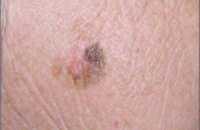 ep melanoma 20181129112501