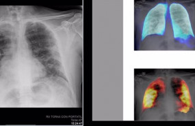ep archivo   tecnicas de inteligencia artificial en radiografias de torax