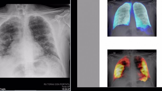 ep archivo   tecnicas de inteligencia artificial en radiografias de torax
