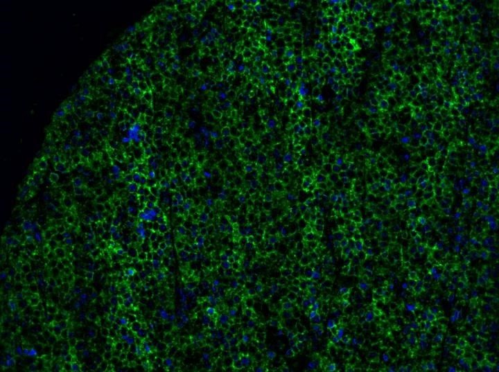 La imagen muestra parte de un tumor de melanoma con expresión de butirofilina 2A1 resaltada en verde y núcleos celulares en azul. | UNIVERSITY OF MELBOURNE ep la imagen muestra parte de un tumor de melanoma con expresion de butirofilina 2a1 resaltada en