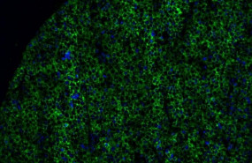 ep la imagen muestra parte de un tumor de melanoma con expresion de butirofilina 2a1 resaltada en