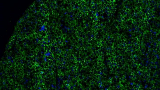 ep la imagen muestra parte de un tumor de melanoma con expresion de butirofilina 2a1 resaltada en