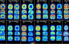 ep petcerebromuestra placas amiloidesproteinas taualzheimer