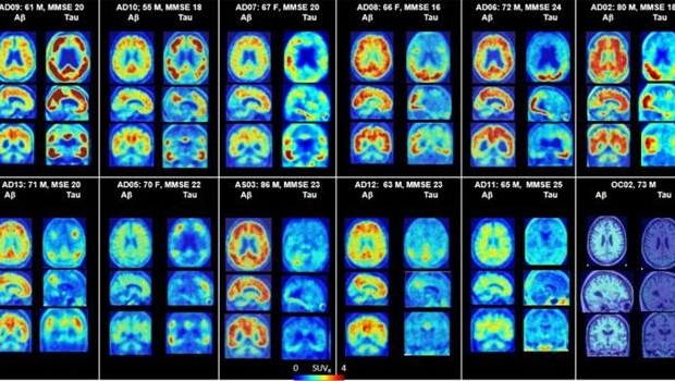 ep petcerebromuestra placas amiloidesproteinas taualzheimer