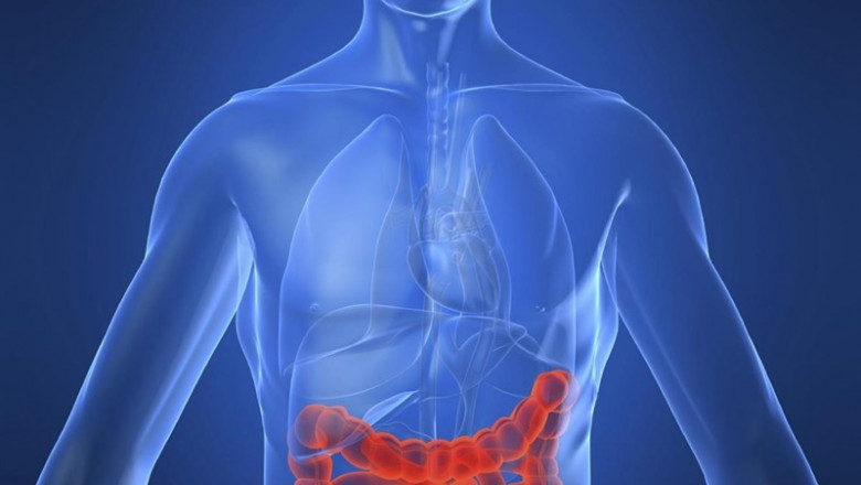 Enfermedad de Crohn, intestino, enfermedad intestinal | BIODESIGN INSTITUTE, ARIZONA STATE UNIVERSITY ep enfermedadcrohn intestino enfermedad intestinal 20190703180911