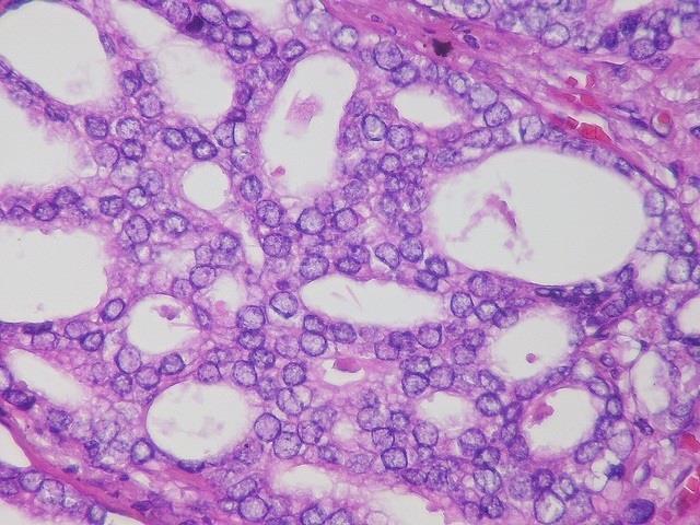 Metastasis de cáncer de prostata | PIXABAY ep metastasiscancerprostata