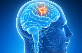 ep tumor cerebral 20190830125818