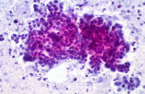 ep cancer de pancreas