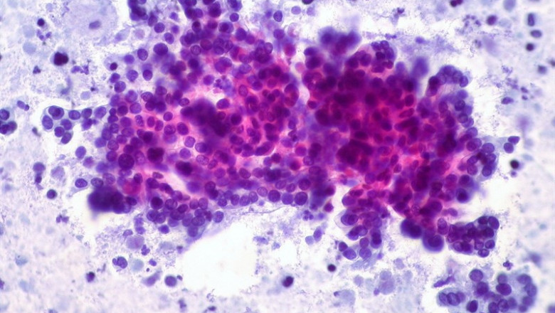 ep cancer de pancreas