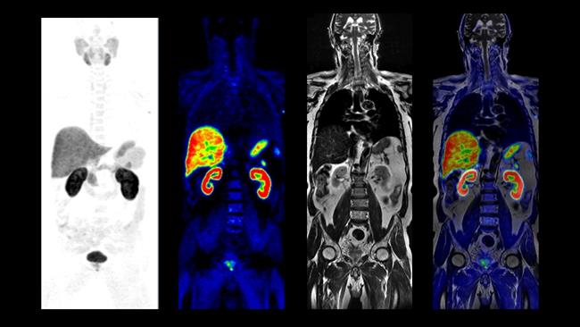 Imagen obtenida por PET/RM | GE HEALTHCARE ep imagen obtenidapetrm