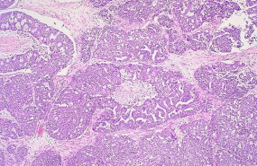 ep cancer de ovario 20200508120103