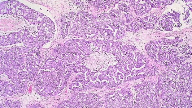 ep cancer de ovario 20200508120103