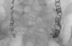 ep embolizacionsindromecongestion pelvica