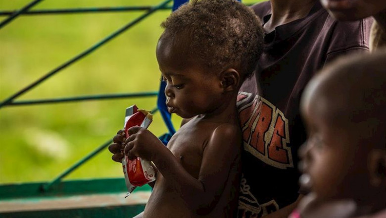 ep un nino desnutrido en republica democratica del congo