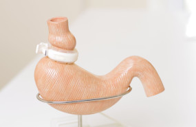 cirugia bariatrica 1 