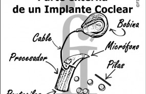 ep implante coclear