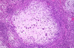 ep sufrir un cancer de mama predispone a desarrollar un cancer ginecologico segun un estudio