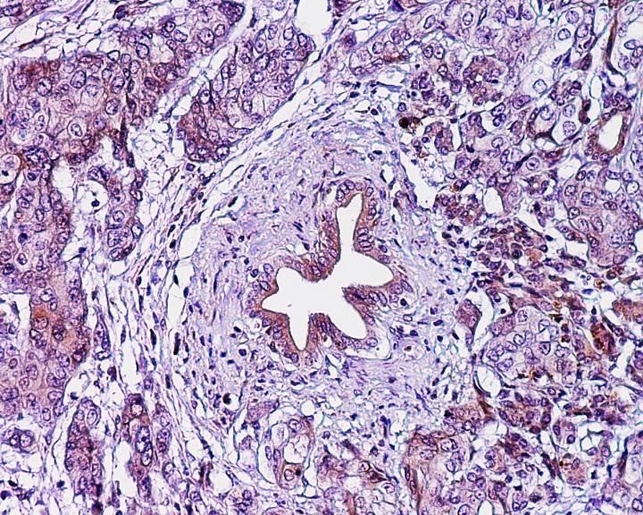 ep adenocarcinoma ductal pancreatico cancer pancreas