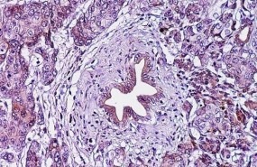 ep adenocarcinoma ductal pancreatico cancer pancreas