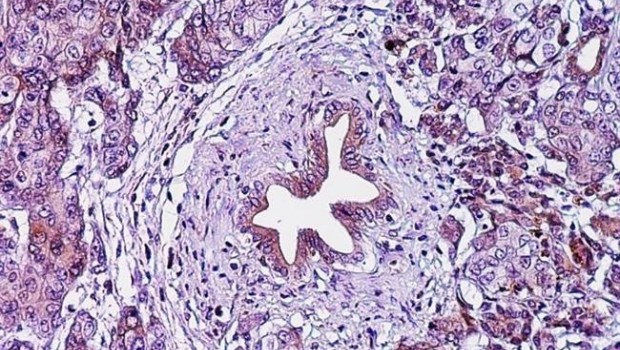 ep adenocarcinoma ductal pancreatico cancer pancreas